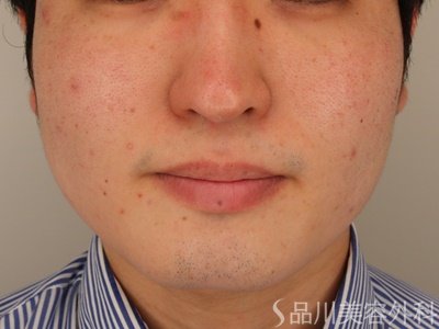 症例NO.72511のBEFORE写真