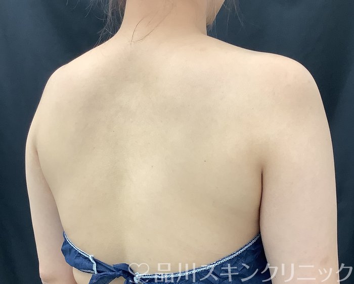 症例NO.67993のAFTER写真