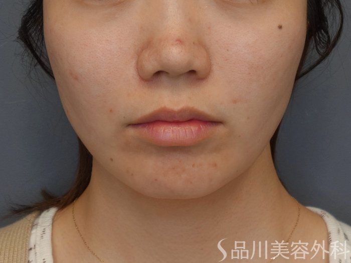 症例NO.74170のAFTER写真