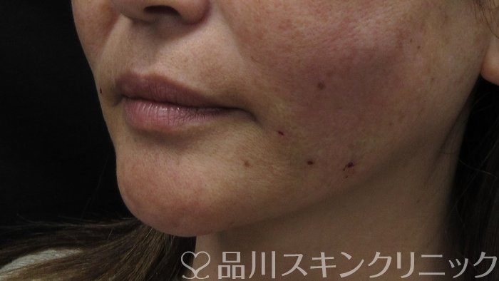 症例NO.71322のAFTER写真
