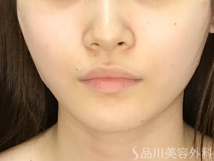 症例NO.71706のAFTER写真