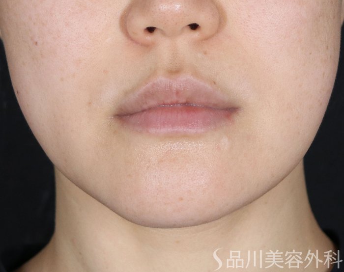 症例NO.74031のBEFORE写真
