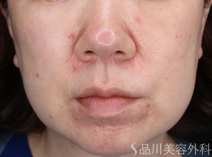症例NO.68737のBEFORE写真