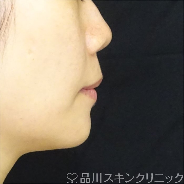 症例NO.69449のBEFORE写真