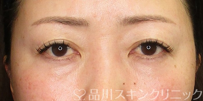 症例NO.70065のBEFORE写真