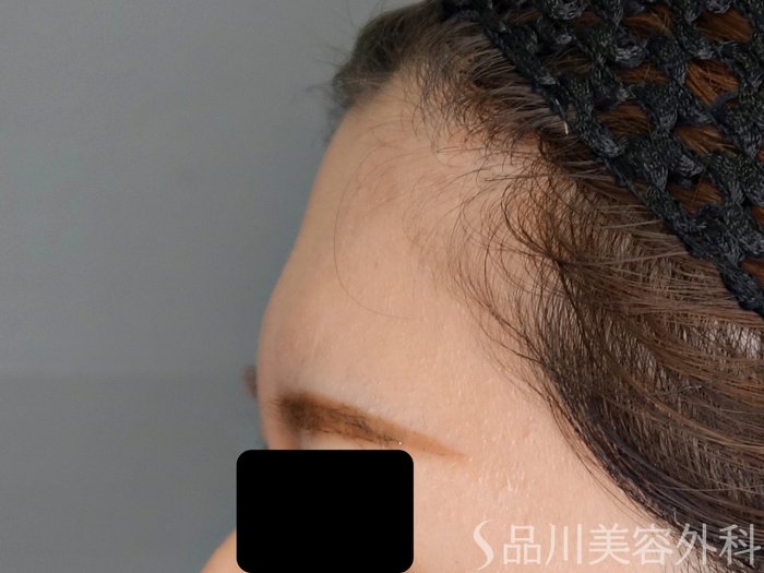 症例NO.68348のBEFORE写真