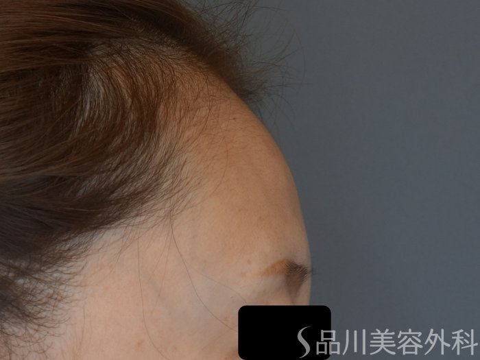 症例NO.72105のBEFORE写真