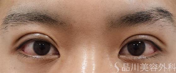 症例NO.50930のAFTER写真