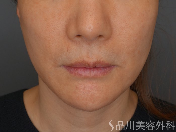 症例NO.68001のBEFORE写真