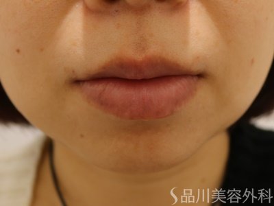 症例NO.62501のAFTER写真