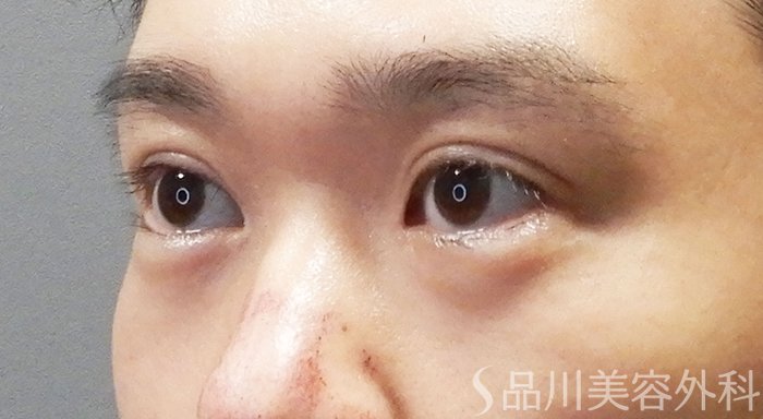 症例NO.71526のAFTER写真