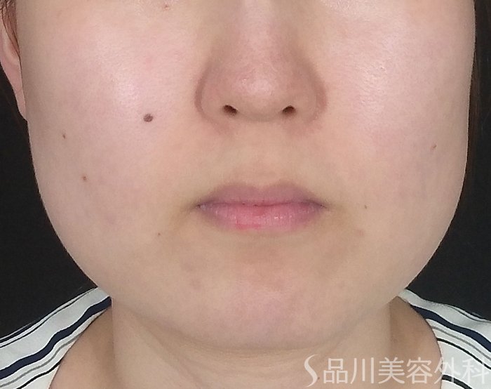 症例NO.65099のBEFORE写真