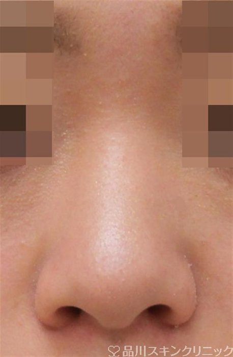 症例NO.42154のBEFORE写真