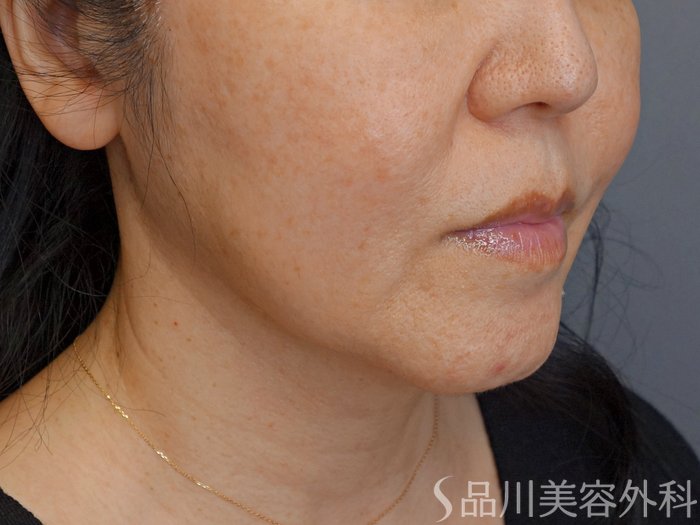 症例NO.72942のBEFORE写真