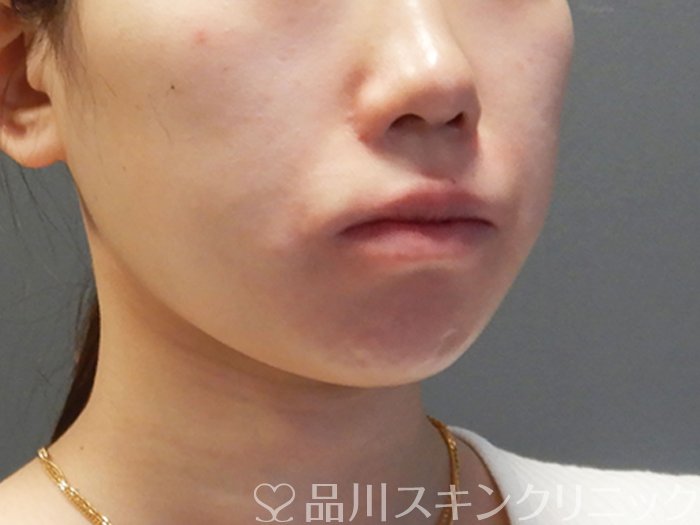 症例NO.73277のBEFORE写真