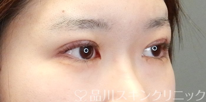 症例NO.63523のAFTER写真
