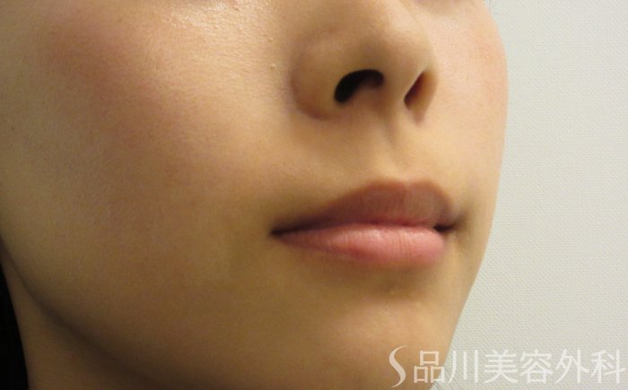 症例NO.74030のBEFORE写真