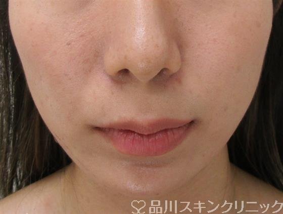 症例NO.36920のAFTER写真