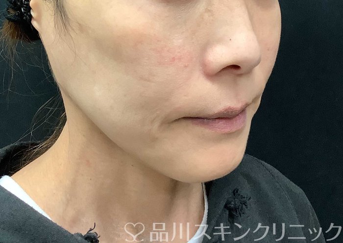 症例NO.71108のBEFORE写真