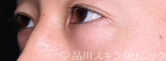 症例NO.74019のBEFORE写真