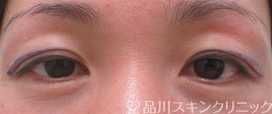 症例NO.26928のBEFORE写真