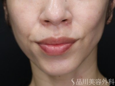 症例NO.72200のBEFORE写真