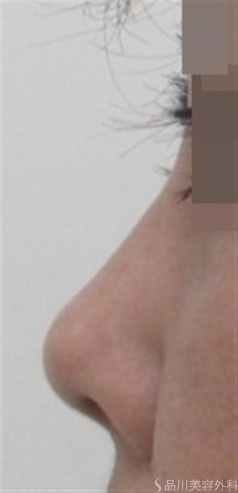 症例NO.22952のBEFORE写真