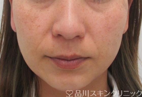 症例NO.27302のBEFORE写真