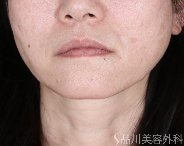 症例NO.72644のAFTER写真