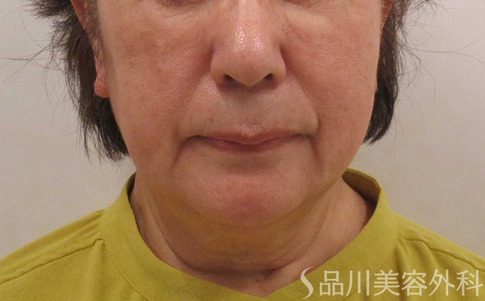 症例NO.70798のBEFORE写真