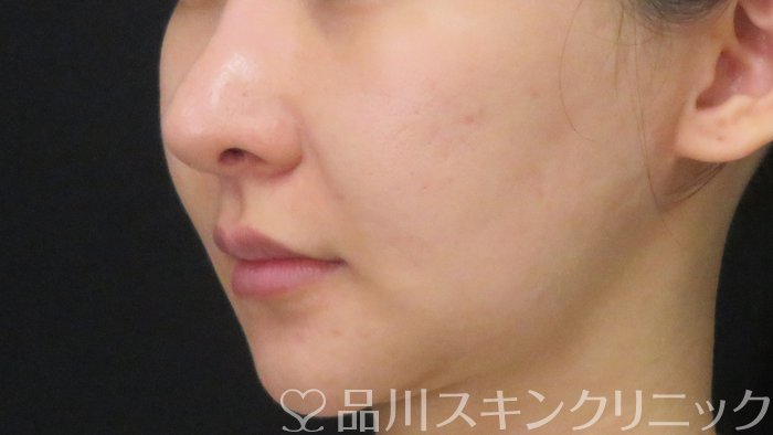 症例NO.71930のAFTER写真