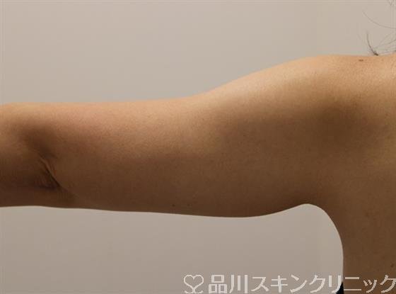 症例NO.45220のBEFORE写真