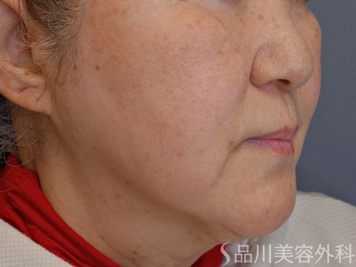 症例NO.73822のBEFORE写真