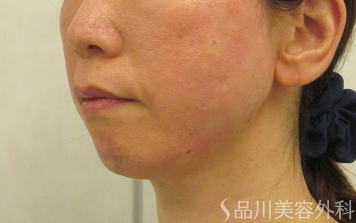 症例NO.73148のAFTER写真