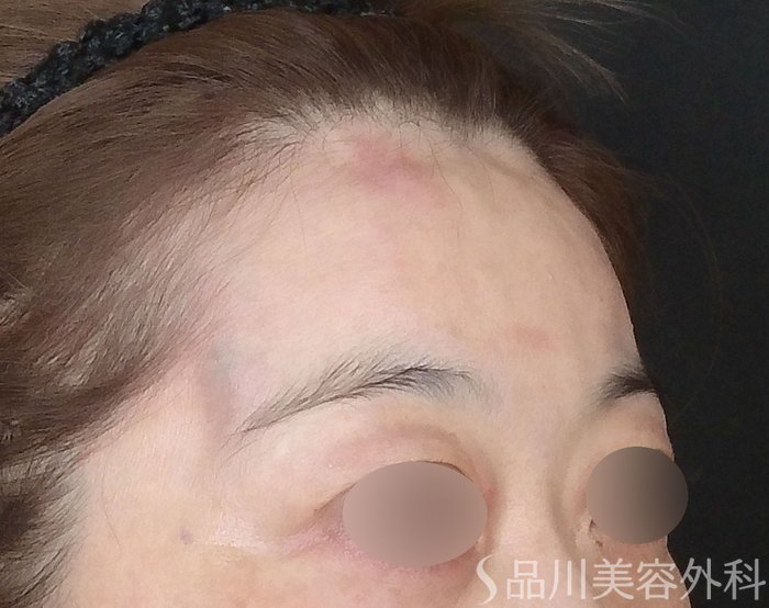 症例NO.70428のAFTER写真