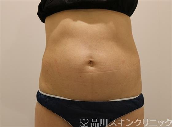 症例NO.43180のBEFORE写真