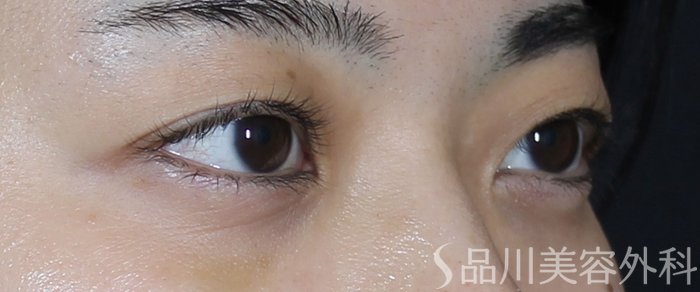 症例NO.71482のBEFORE写真