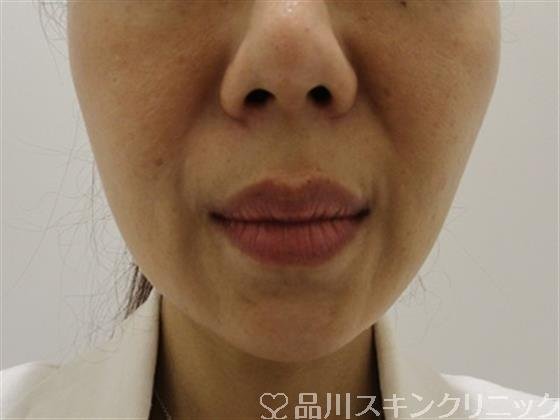 症例NO.38625のBEFORE写真