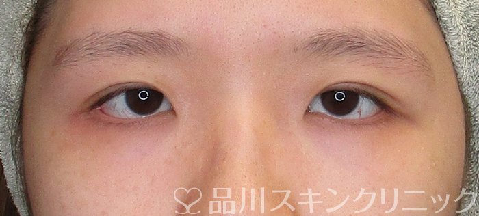 症例NO.72670のAFTER写真