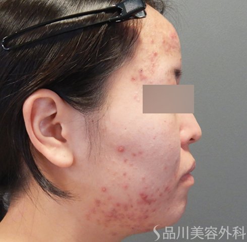 症例NO.70456のBEFORE写真