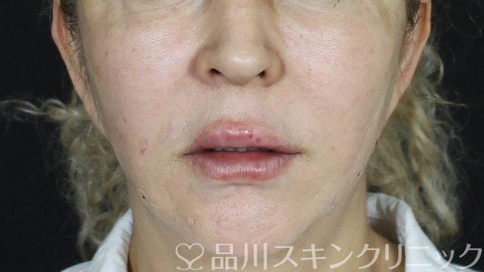 症例NO.72001のAFTER写真