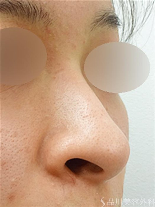 症例NO.33348のBEFORE写真