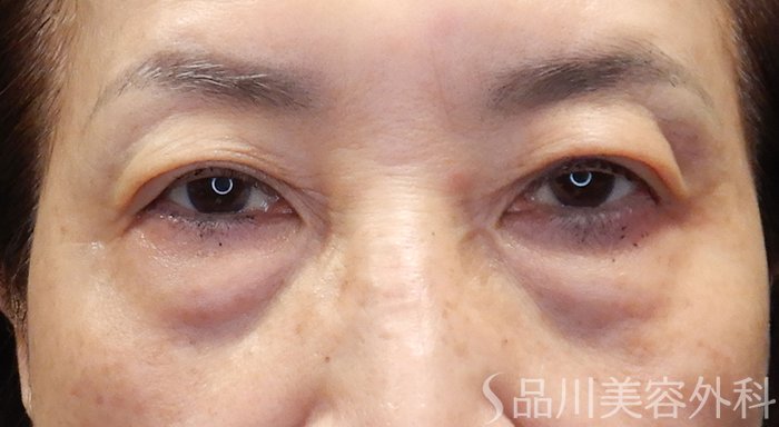 症例NO.69897のBEFORE写真