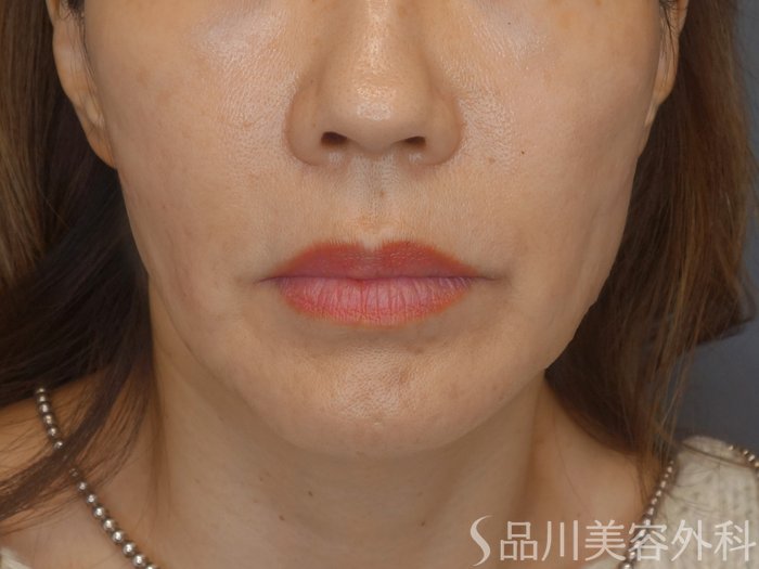 症例NO.72060のAFTER写真