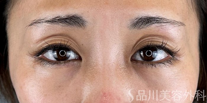 症例NO.68042のBEFORE写真