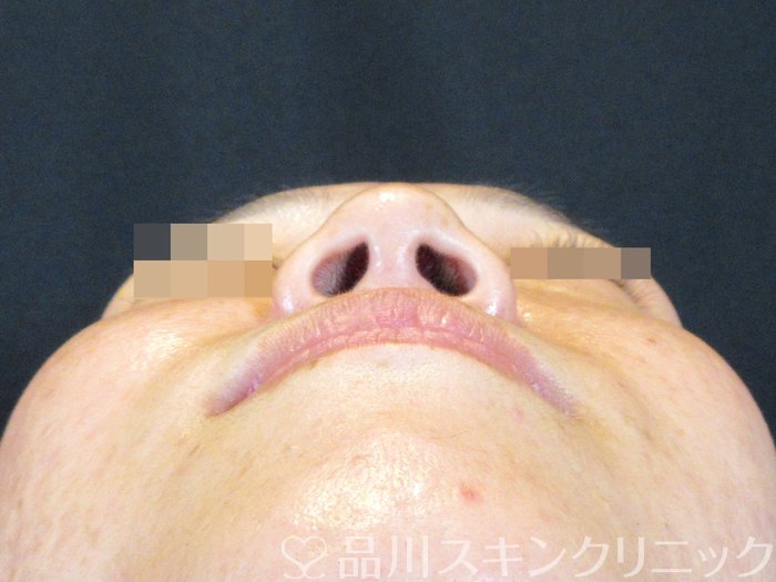 症例NO.75373のBEFORE写真