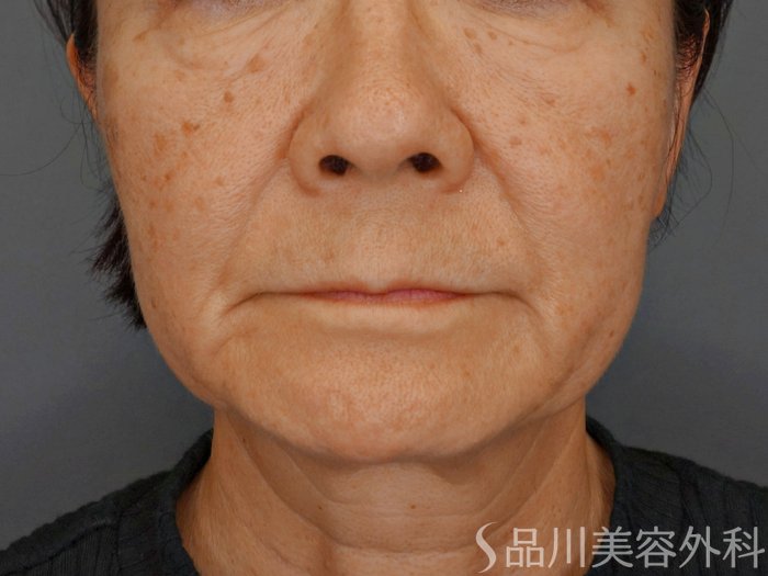 症例NO.74080のBEFORE写真
