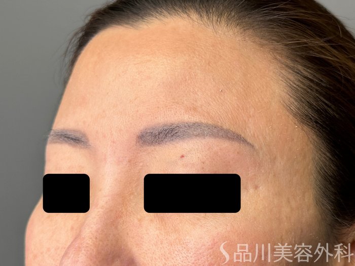 症例NO.75036のBEFORE写真