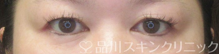 症例NO.64056のBEFORE写真