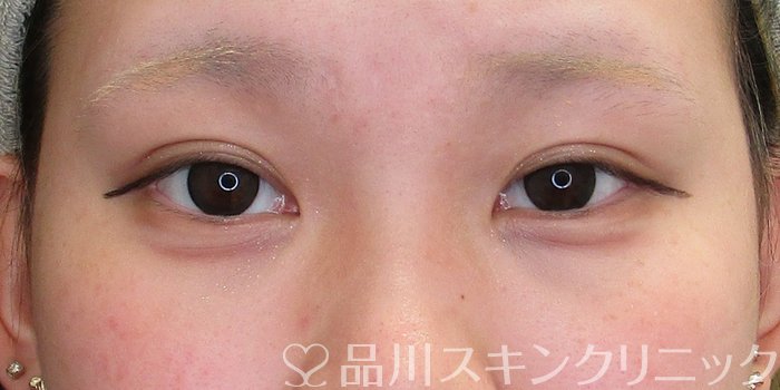 症例NO.73459のAFTER写真